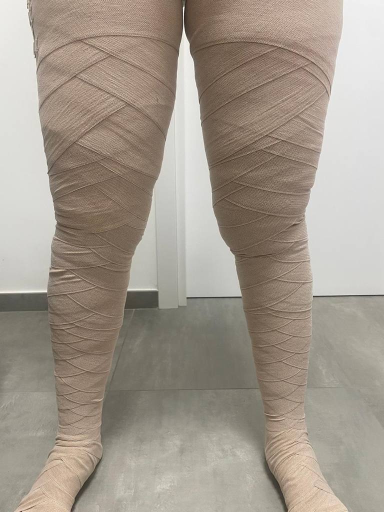 Gambe bendate con bendaggio elastocompressivo dopo un trattamento di linfodrenaggio nello studio di Vibo Valentia